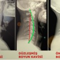 Boyun Düzleşmesi Nedir Nasıl Tedavi Edilir?